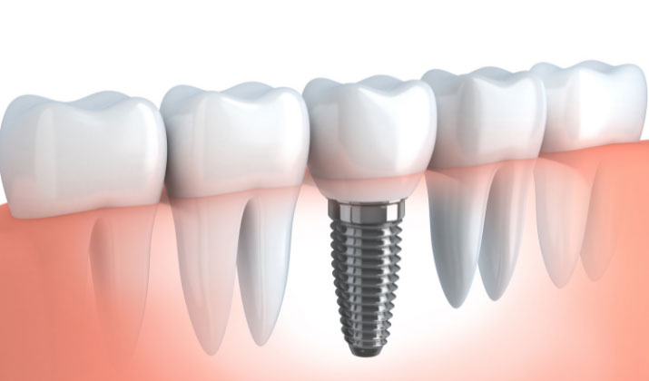 visual representation of dental implants in Beaumont. Provided at Serenity Dental
