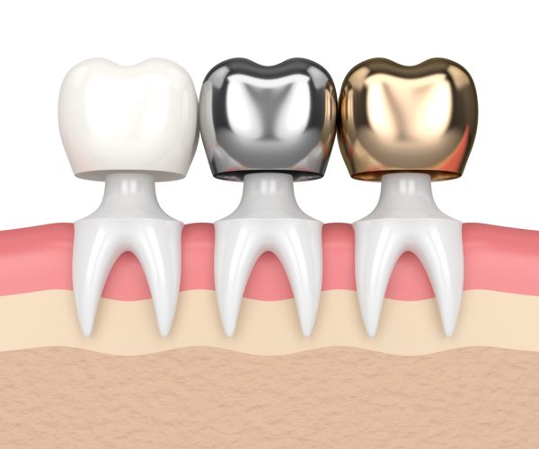 beaumont dental crowns at Serenity Dental