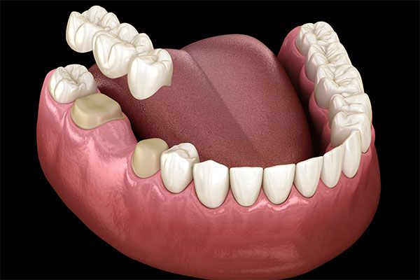 Restorative dentistry at Serenity Dental in Beaumont