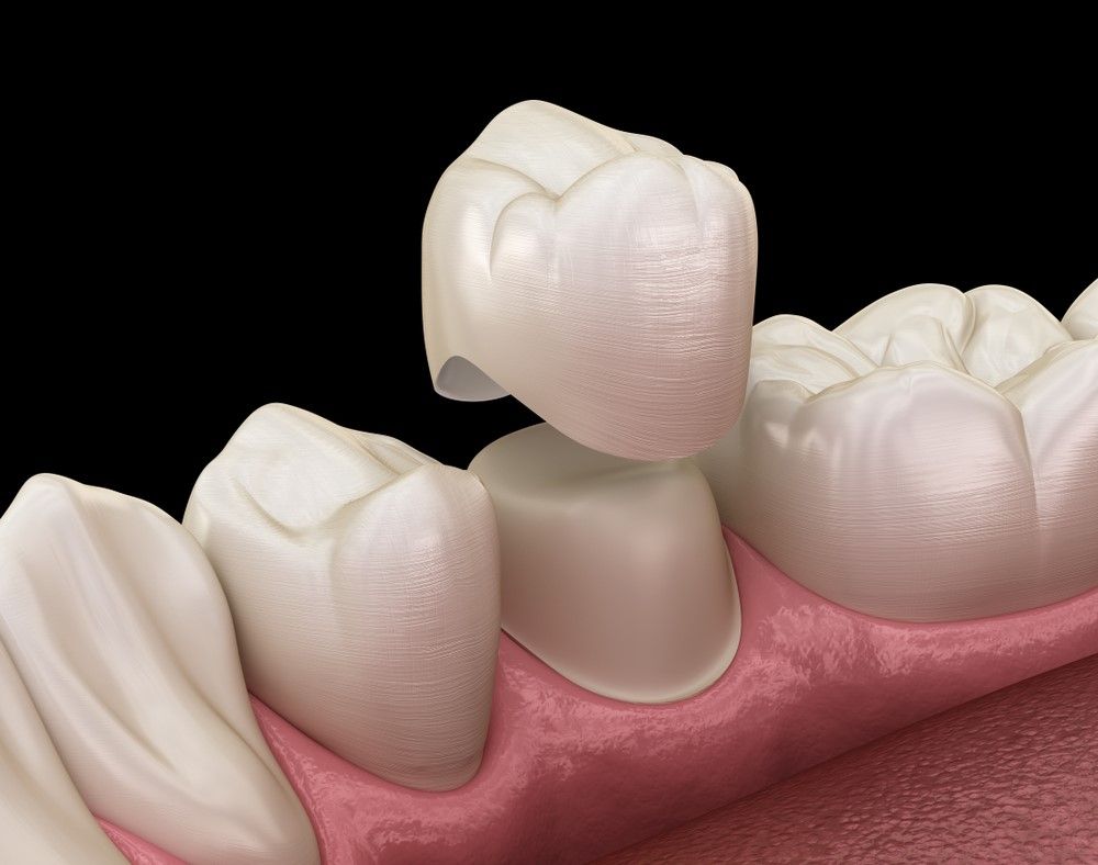 Dental restorations at Serenity Dental