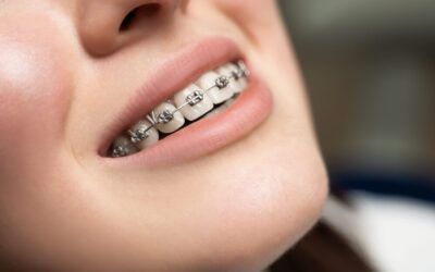 Understanding the Different Types of Braces