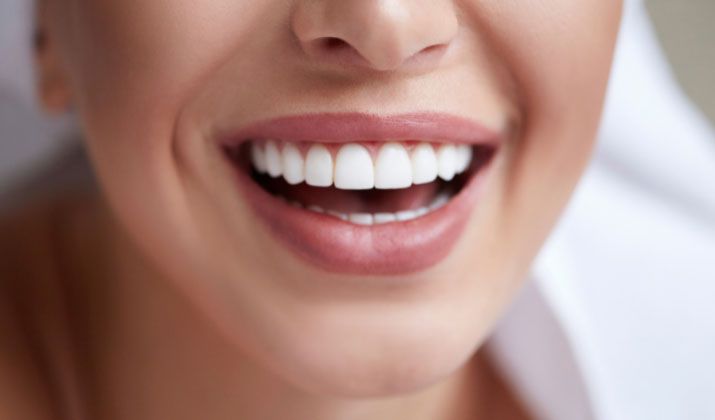 Porcelain veneers at Serenity Dental in Beaumont