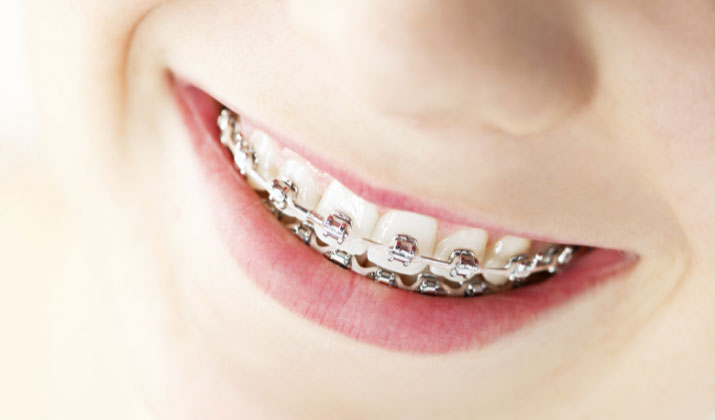 orthodontic braces in beaumont ab