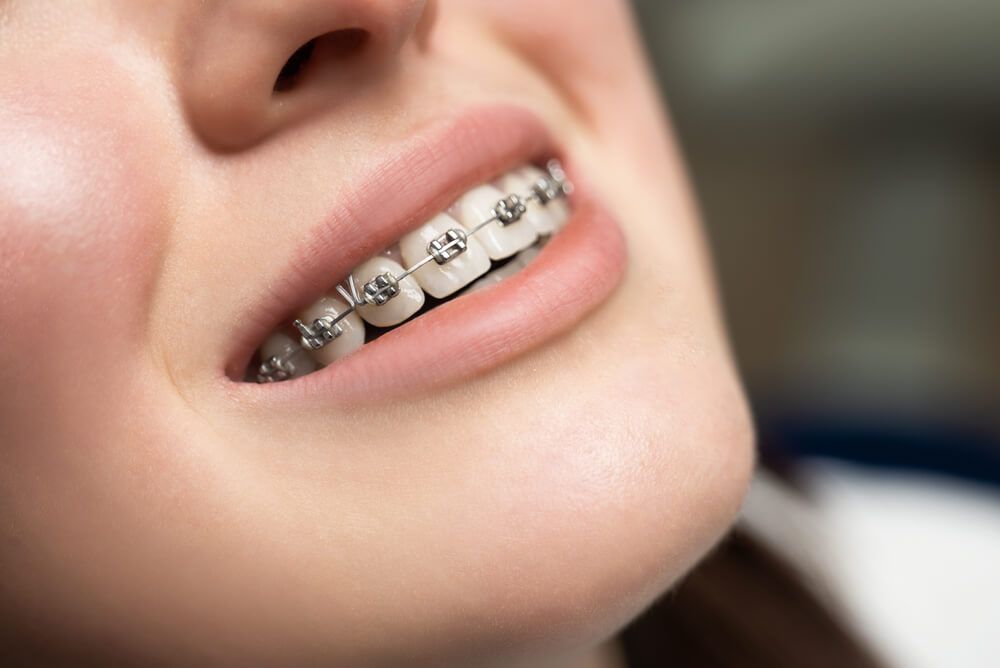 types of braces